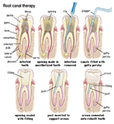 endodontic