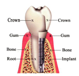 implants