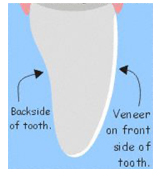 veneer